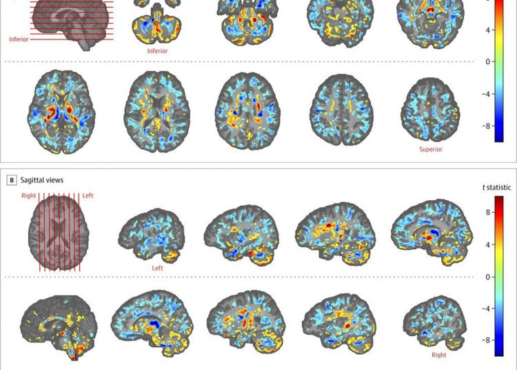 Photo of various brain scans of U.S. officials who were in Cuba, compared to those of a control group, in a photo provided by the American Medical Association in July 2019. (American Medical Association via AP)