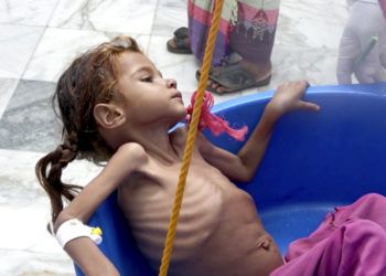 En esta imagen del 25 de agosto de 2018, de una captura de video, se pesa a una niña con un elevado nivel de desnutrición en el Centro de Salud Aslam de Hajjah, Yemen. (AP Foto/Hammadi Issa, Archivo)