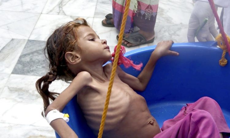 En esta imagen del 25 de agosto de 2018, de una captura de video, se pesa a una niña con un elevado nivel de desnutrición en el Centro de Salud Aslam de Hajjah, Yemen. (AP Foto/Hammadi Issa, Archivo)