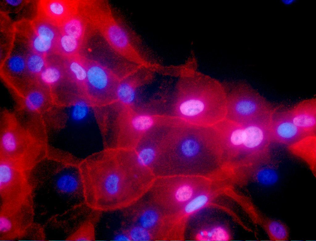 En esta fotografía sin fecha se muestran células de cáncer de mama. Foto: Ewa Krawczyk/National Cancer Institute vía AP / Archivo.