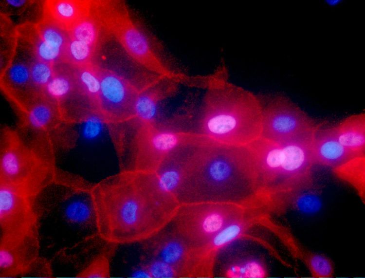 En esta fotografía sin fecha se muestran células de cáncer de mama. Foto: Ewa Krawczyk/National Cancer Institute vía AP / Archivo.