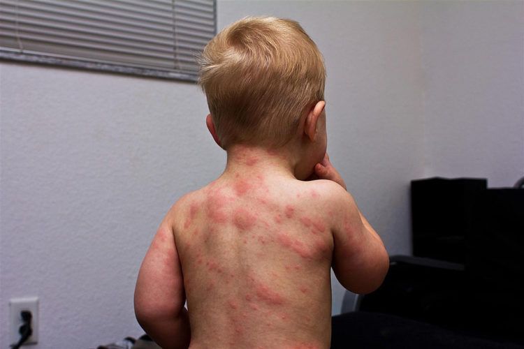 Niño enfermo con sarampión en Estados Unidos. Foto: newsweekespanol.com