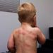 Niño enfermo con sarampión en Estados Unidos. Foto: newsweekespanol.com