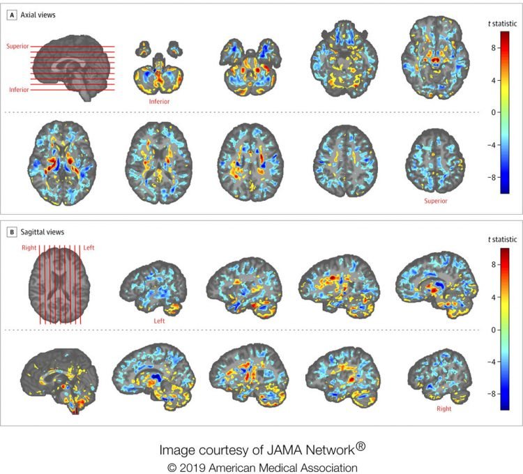 Foto de diversas tomografías cerebrales de funcionarios estadounidenses que estaban en Cuba, comparadas con las de un grupo de control, en una foto suministrada por la Asociación Médica de EEUU en julio del 2019. (Asociación Médica de EEUU via AP)