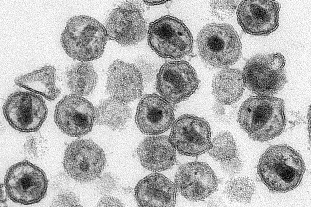 Esta imagen tomada con un microscopio electrónico y difundida por los Centros para el Control y la Prevención de Enfermedades de Estados Unidos (CDC, por sus siglas en inglés) muestra viriones del VIH. Foto: Maureen Metcalfe, Tom Hodge/CDC vía AP.