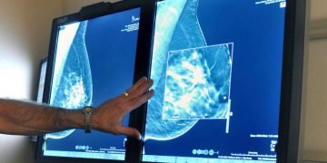 Imagen de archivo que muestra una prueba de detección de cáncer de mama. Foto: Torin Halsey/Times Record News vía AP/Archivo.