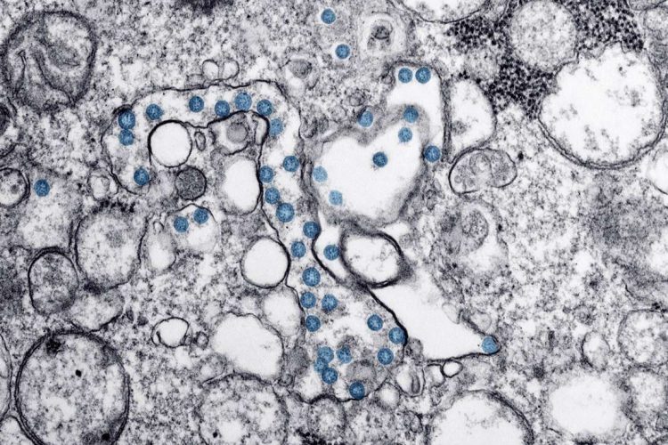 Partículas del virus SARS-CoV-2, coloreadas en azul, en una imagen de microscopio de electrones. Foto: EFE/Imagen cedida por el Consejo Superior de Investigaciones Científicas (CSIC).