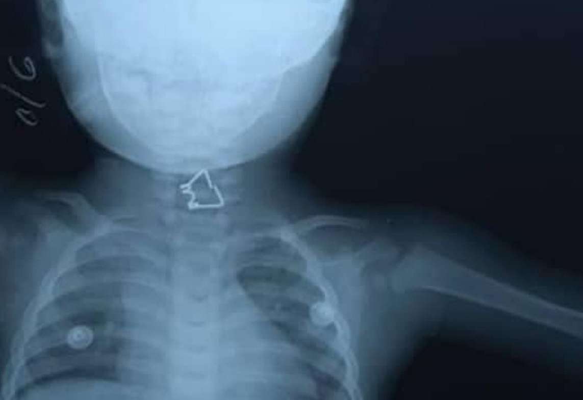 They save a child in Holguín who swallowed a metal spring