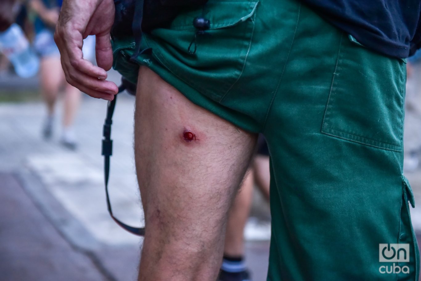 Víctima de balas de goma durante las manifestaciones en las afueras del Congreso contra la mega Ley Ómnibus. Foto: Kaloian.