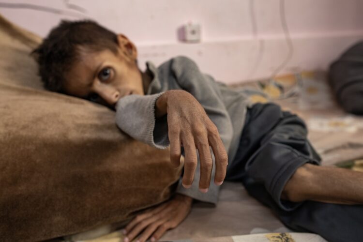 Niño palestino de cinco años, Osama al-Raqab, sufre desnutrición severa, recibe tratamiento en el Hospital Nasser en Khan Yunis, sur de la Franja de Gaza. Foto: HAITHAM IMAD/EFE/EPA