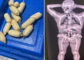 Cápsulas de cocaína detectadas por la Aduana de Cuba cuando intentaban introducirlas en el aeropuerto de La Habana. Foto: Tomada del perfil en X de Wiliam Pérez González, vice jefe primero de la Aduana General de la República de Cuba.