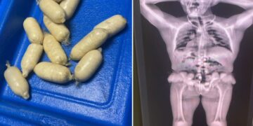 Cápsulas de cocaína detectadas por la Aduana de Cuba cuando intentaban introducirlas en el aeropuerto de La Habana. Foto: Tomada del perfil en X de Wiliam Pérez González, vice jefe primero de la Aduana General de la República de Cuba.